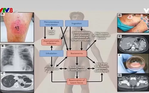Ninh Thuận: Điều trị thành công ca bệnh Whitmore