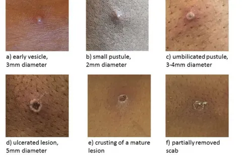 Bình đẳng y tế nhìn từ bệnh đậu mùa khỉ