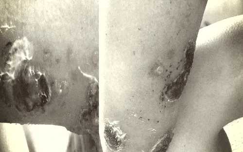 Cứu sống bệnh nhân mắc bệnh da liễu hiếm gặp với tỷ lệ mắc chỉ 2/1.000.000