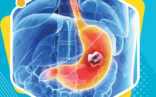 Khám và tư vấn miễn phí bệnh lý ung thư dạ dày