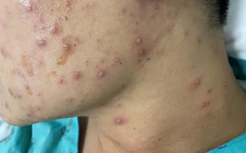 Cảnh giác với bệnh thủy đậu mùa đông xuân