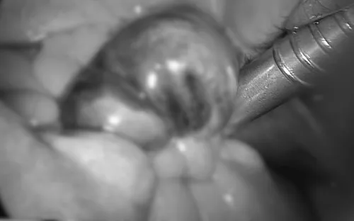 Bất ngờ phát hiện u buồng trứng ở một bé gái 10 tuổi