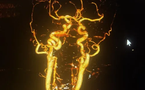 Bệnh nhân thoát khỏi tàn phế nhờ hiểu biết về đột quỵ