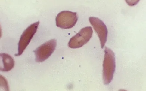 Anh phê duyệt liệu pháp gen điều trị bệnh hồng cầu hình liềm đầu tiên trên thế giới