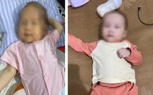 Thiếu hụt citrin - rối loạn chuyển hóa hiếm gặp ở trẻ