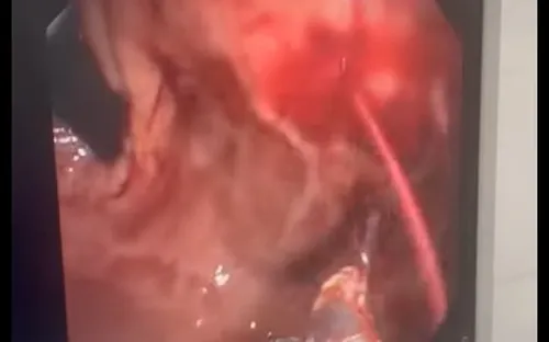 Cứu sống bệnh nhân xuất huyết tiêu hóa nguy kịch, máu phun thành tia