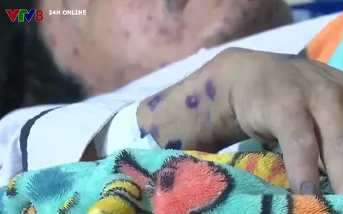 Dịch bệnh thủy đậu lan rộng ở Đắk Lắk