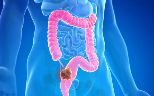 Vì sao ngày càng nhiều người mắc bệnh ung thư đại tràng?