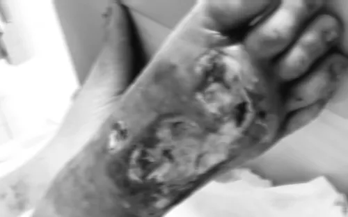 Người bệnh đái tháo đường suýt phải đoạn chi do nhiễm trùng huyết