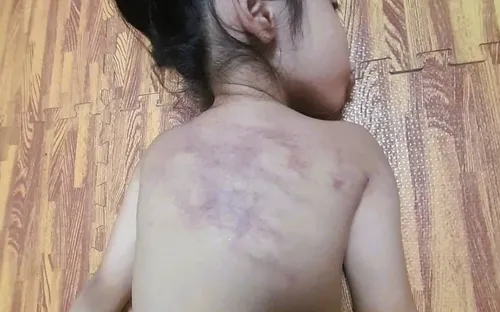 Chủ tịch TP Hải Phòng chỉ đạo xem xét trách nhiệm vụ bé gái 5 tuổi bị bầm tím ở vùng lưng