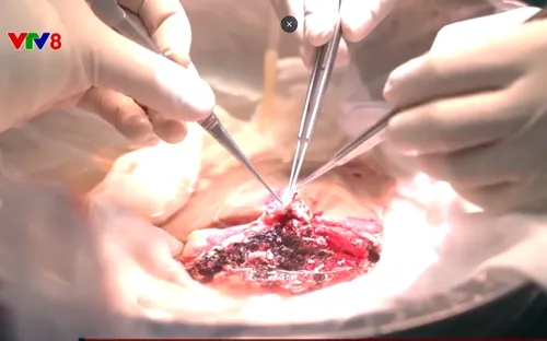 Bé trai hồi sinh sự sống nhờ ghép gan