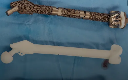 Thay xương đùi nhân tạo bằng công nghệ 3D