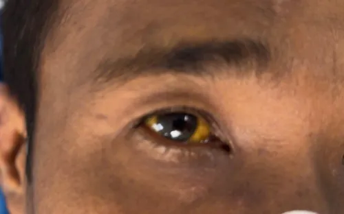 Nguy kịch vì tự ý dừng thuốc điều trị viêm gan