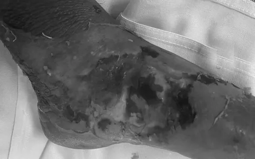 Nhiễm trùng nặng vì tự ý đắp thuốc sau khi bị rắn cắn