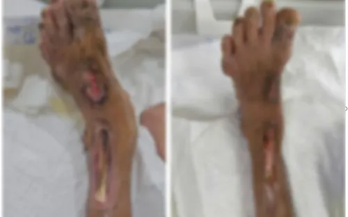 Nguy cơ tử vong từ thói quen xử lý vết mủ sai cách