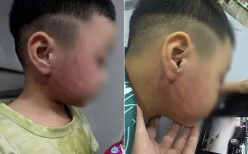 Hà Nội: Bé 4 tuổi nghi bị giáo viên mầm non bạo hành, công an khẩn trương vào cuộc