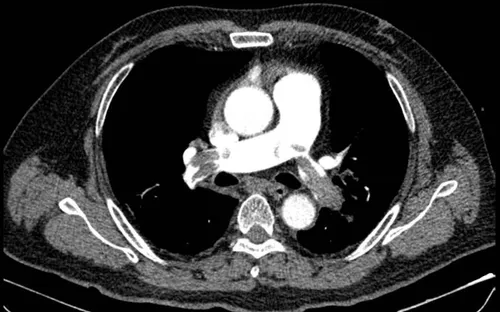 Cấp cứu kịp thời ca thuyên tắc phổi ở người bệnh hút thuốc lá