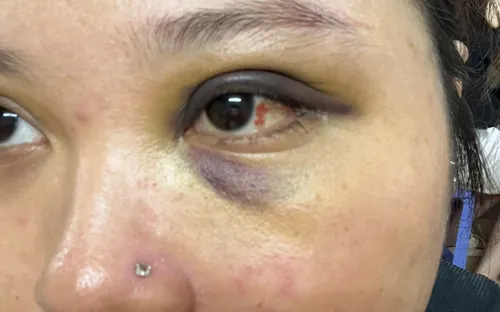 Đang uống cà phê, người phụ nữ ở Hà Nội bị đánh gãy xương hốc mắt