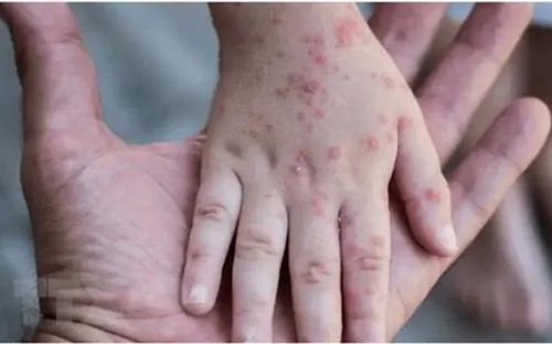 Anh ghi nhận ca đầu tiên nhiễm chủng mới Virus đậu mùa khỉ: Cảnh báo Y tế toàn cầu