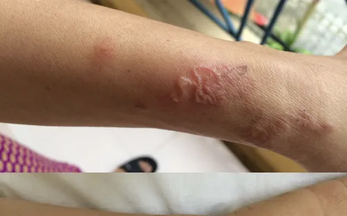 Khánh Hòa: Hàng nghìn người nhập viện vì nhiễm giun đũa chó mèo