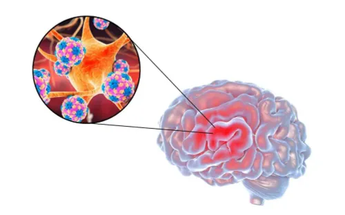 Cảnh báo bệnh não mô cầu xâm lấn gia tăng và nguy cơ tử vong nhanh