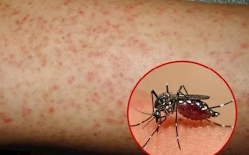 Sốt xuất huyết diễn biến phức tạp: Thế giới ghi nhận 13 ca tử vong mỗi ngày