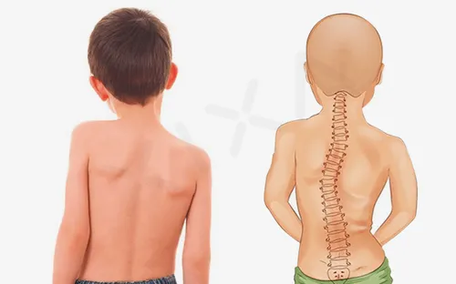 Báo động tình trạng vẹo cột sống do thói quen sử dụng máy tính bảng sai cách ở trẻ em