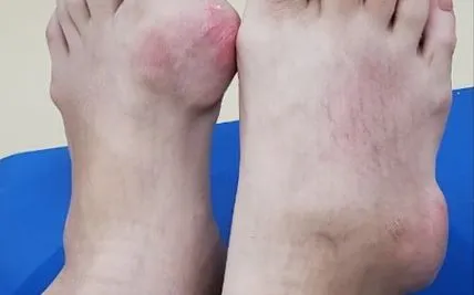 Khớp tay chân biến dạng đáng sợ vì biến chứng bệnh gout