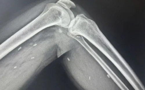 Phát hiện nhiều kén sán ở chân người đàn ông Quảng Trị do thói quen ăn rau sống