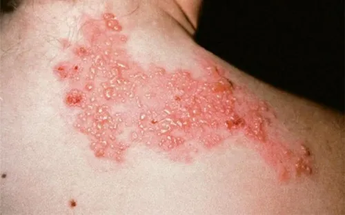 Đau sau zona thần kinh – cơn ám ảnh kéo dài, thách thức lớn của y học hiện đại