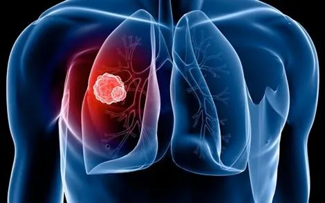 5 dấu hiệu ung thư phổi có thể phát hiện sớm, tuyệt đối không nên bỏ qua