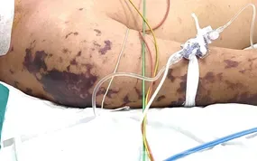 Tự ý đắp thuốc nam chữa zona, nhiều bệnh nhân nhập viện vì viêm da nặng