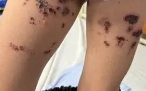 Trẻ bỏng nặng vùng kín do hóa chất tẩy bồn cầu, nhập viện muộn sau 10 ngày