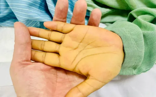 Cô gái 29 tuổi suy gan cấp sau khi tự dùng thuốc nam chữa đau dạ dày