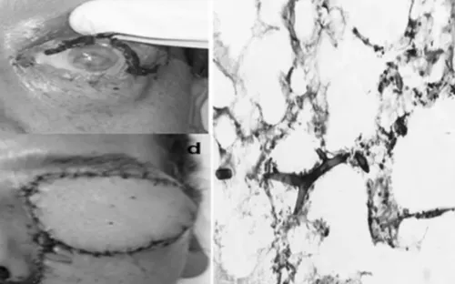 Phát hiện ca nấm đen xâm lấn não tại Phú Thọ, nguy cơ tử vong cao nếu chậm trễ