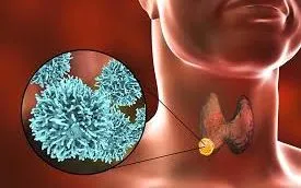 Nhận diện sớm dấu hiệu nguy hiểm của nhân tuyến giáp