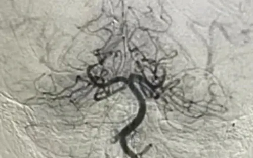 Bé trai 10 tuổi thoát liệt nửa người nhờ can thiệp kịp thời nhồi máu não hiếm gặp