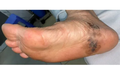 Ung thư hắc tố ở bàn tay, bàn chân dễ bị bỏ sót do vị trí khó nhận biết