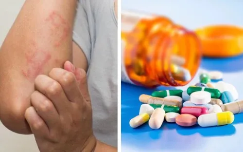 Dị ứng thuốc chiếm tới 20% phản ứng bất lợi, có thể nguy hiểm tính mạng