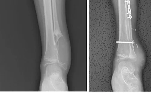 Phẫu thuật tái tạo mắt cá ngoài, giữ chi cho bé gái 8 tuổi mắc ung thư sụn