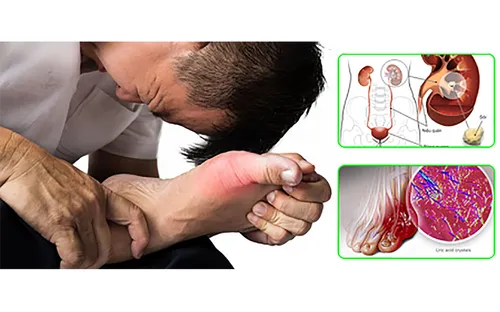 Những thói quen làm tăng acid uric trong máu, dễ dẫn đến gout