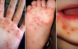 Hà Nội ghi nhận 769 ca tay chân miệng từ đầu năm, xuất hiện thêm ổ dịch mới