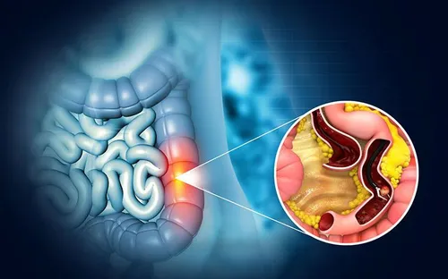 Hội chứng Lynch: Rối loạn di truyền làm tăng nguy cơ nhiều loại ung thư