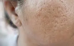 Sẹo rỗ có tự đầy lên theo thời gian? Chuyên gia giải đáp và cách cải thiện hiệu quả