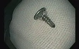 Bé trai 6 tuổi nuốt ốc vít sắt, được cấp cứu kịp thời, không tổn thương nghiêm trọng