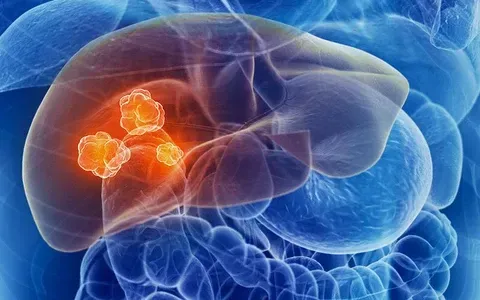 Viêm gan B, C và rượu bia thúc đẩy ung thư gan trẻ hóa tại Việt Nam