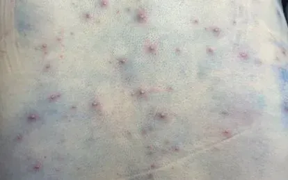 Thủy đậu dễ lây lan, có thể gây biến chứng nguy hiểm nếu chăm sóc sai cách