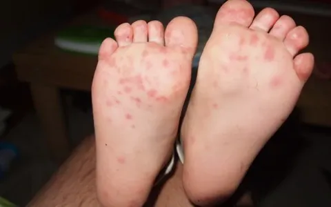 Ca tay chân miệng tăng gần gấp đôi tại TP.HCM, sốt xuất huyết giảm