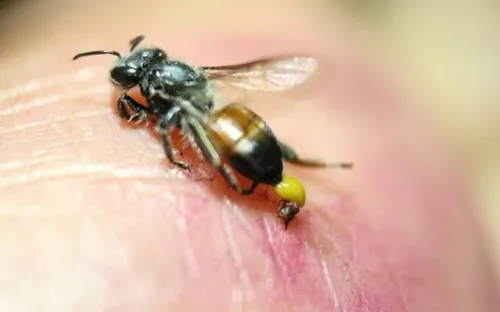 Bé 7 tuổi nhập viện cấp cứu sau khi bị ong vò vẽ đốt tại trường học