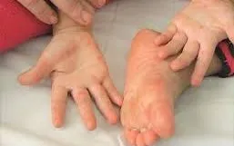 Chủ động phòng ngừa bệnh chân tay miệng ở trẻ nhỏ